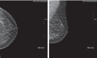 Why Marking Scars in Mammography Helps Image Interpretation