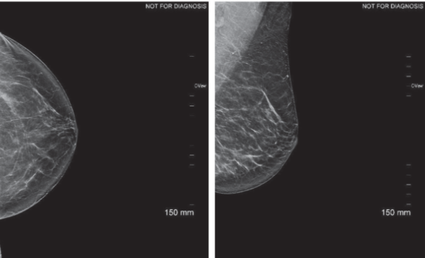 61 yo patient presenting for screening mammography. No report of previous surgery. Architectural distortion identified in both views left breast