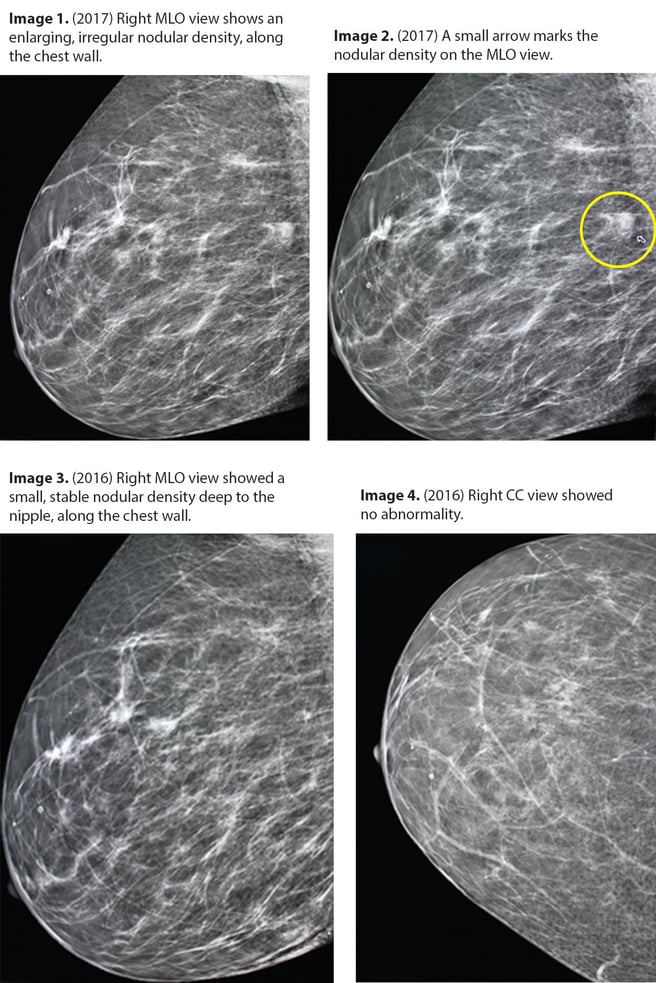 Breast Cancer Moles and Spots