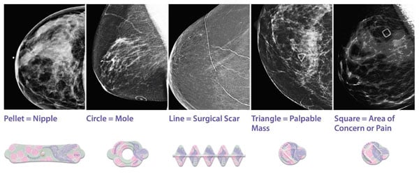 How Use of Mammography Skin Markers Improves Patient Perception of Care