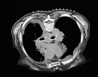 GuideLines visible on a CT scan