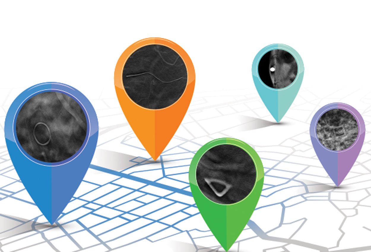 Radiologist Perspective on the Value of Skin Markers in Digital Breast