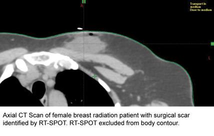 X-ray: Axial CT Scan of female breast radiation patient with sugical scar, identified by RT-SPOT. RT-SPOT excluded from body contour.