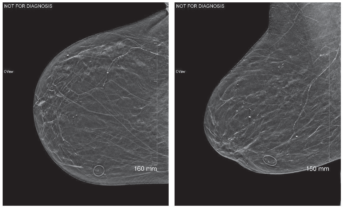 Why Mark Moles in Digital Breast Tomosynthesis? A Radiologist Perspective
