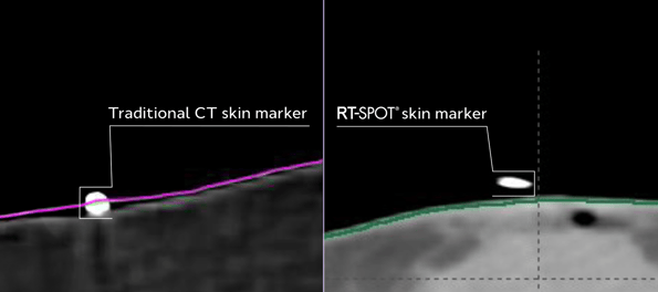 A traditional CT skin marker in comparison to a RT spot skin marker
