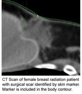 X-ray: CT Scan of female breast radiation patient with surgical scar