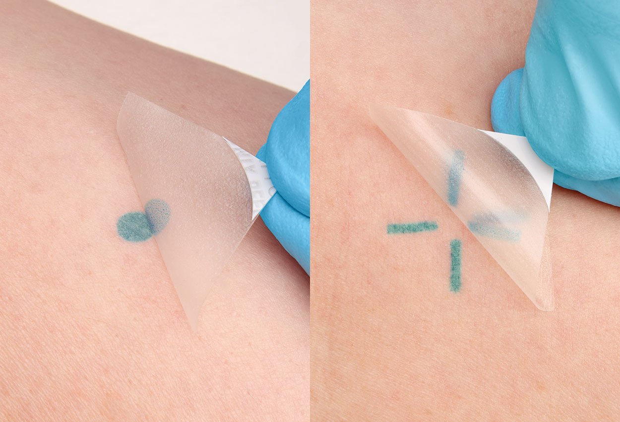 future treatment setup marks with InkRight - Dot and Crosshair images pictured