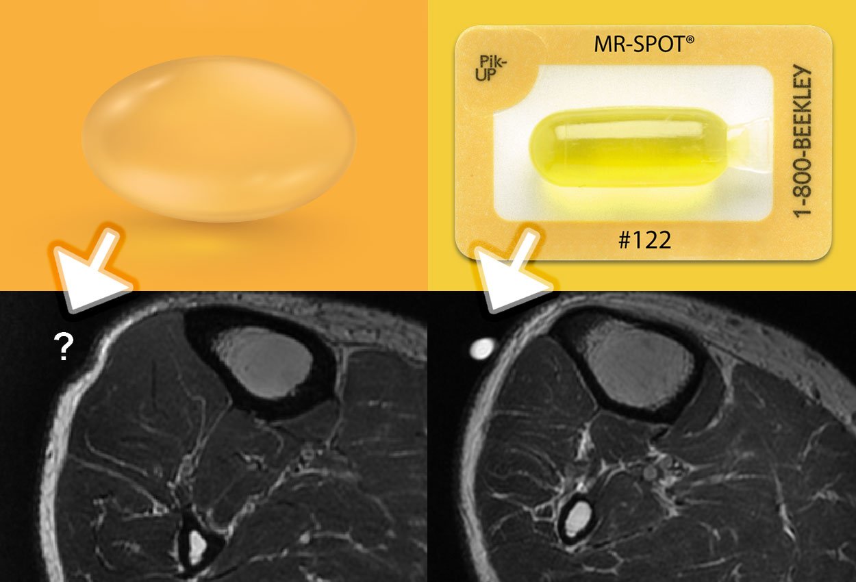 vitamin E makeshift vs. MR-SPOT skin marker