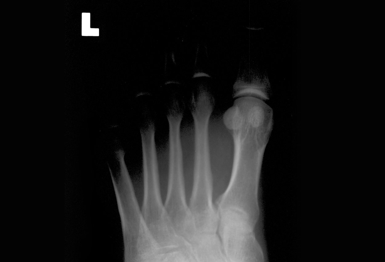 X-ray Marker Parker STUDENT BONES 