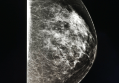 black and white mammogram image