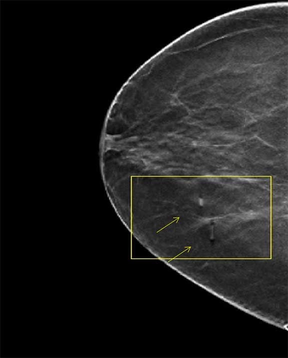 Why Consistency, Clarity, and Clear Communication Systems in Breast Imaging are More Essential