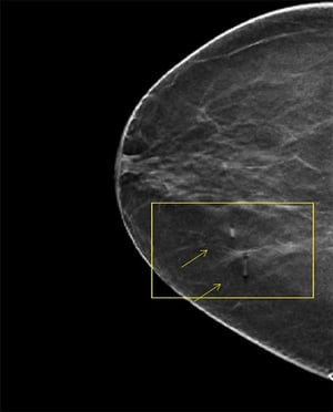 1.5 metallic pellet marker indicating moles on a digital breast tomosynthesis (DBT) image slice