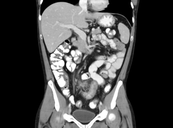 The Importance Of Oral Contrast In CT Abdominal Imaging   Opacified 