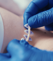 A technologist applying RT-SPOT line to a patient's scar.