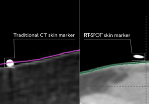 side by side comparison of a traditional skin marker being including in the automatic body contour on the left and RT-SPOT skin marker above the body contour on the right