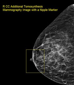 Tomosynthesis