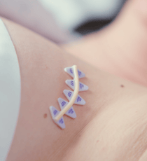 RT-SPOT line placed on a patient