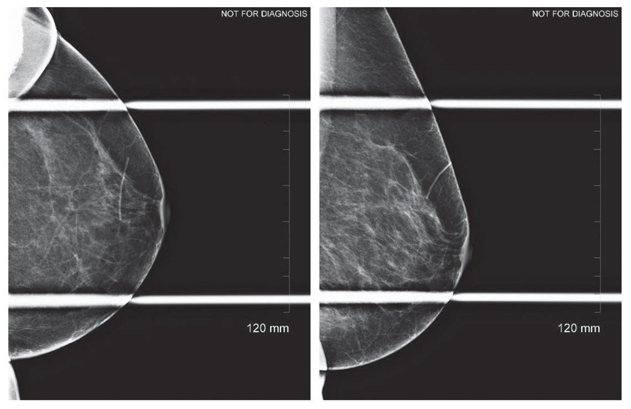 Spot compression shows architectural distortion adjacent to linear marker in L LMO view