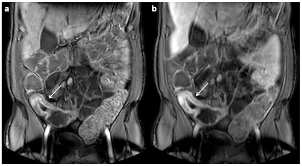 x-ray: bowel wall thickened in MRE