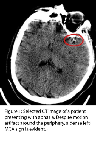 Figure 1: Selected CT image of a patient presenting with aphasia