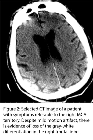 Figure 2: Selected CT image of a patient with symptoms referable to the right MCA territory