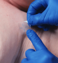 InkRight tattoos being placed on a patient's skin