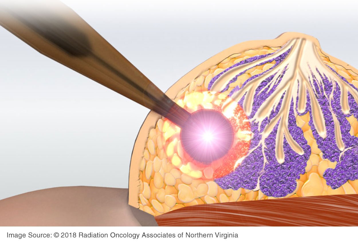 intraoperative_radiotherapy_treatment