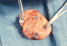 three margin map charms sutured to a specimen on a blue medical blanket 