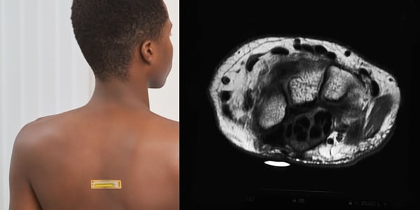 An example of MR-SPOT on a patient's back and how it shows on a scan.