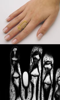 A MR-SPOT between fingers and how it shows up on the scan