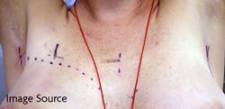 Permanent vs. Temporary Set-Up Marks in Radiation Therapy