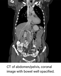 Abdominal X-ray with Gastrografin oral contrast media seen in the large