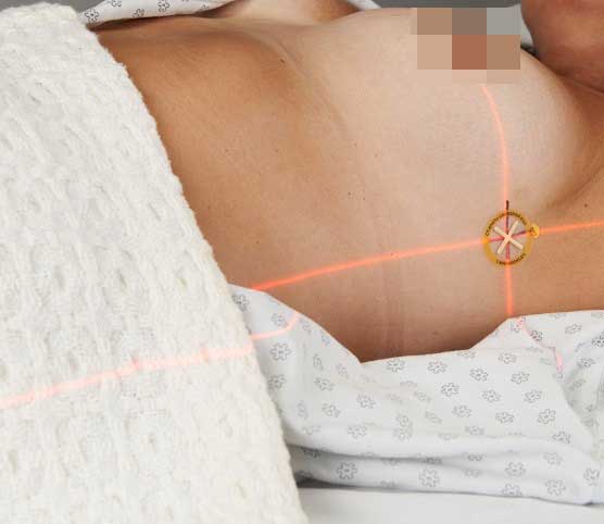 Lasers on patient's skin are projected as a 't'...