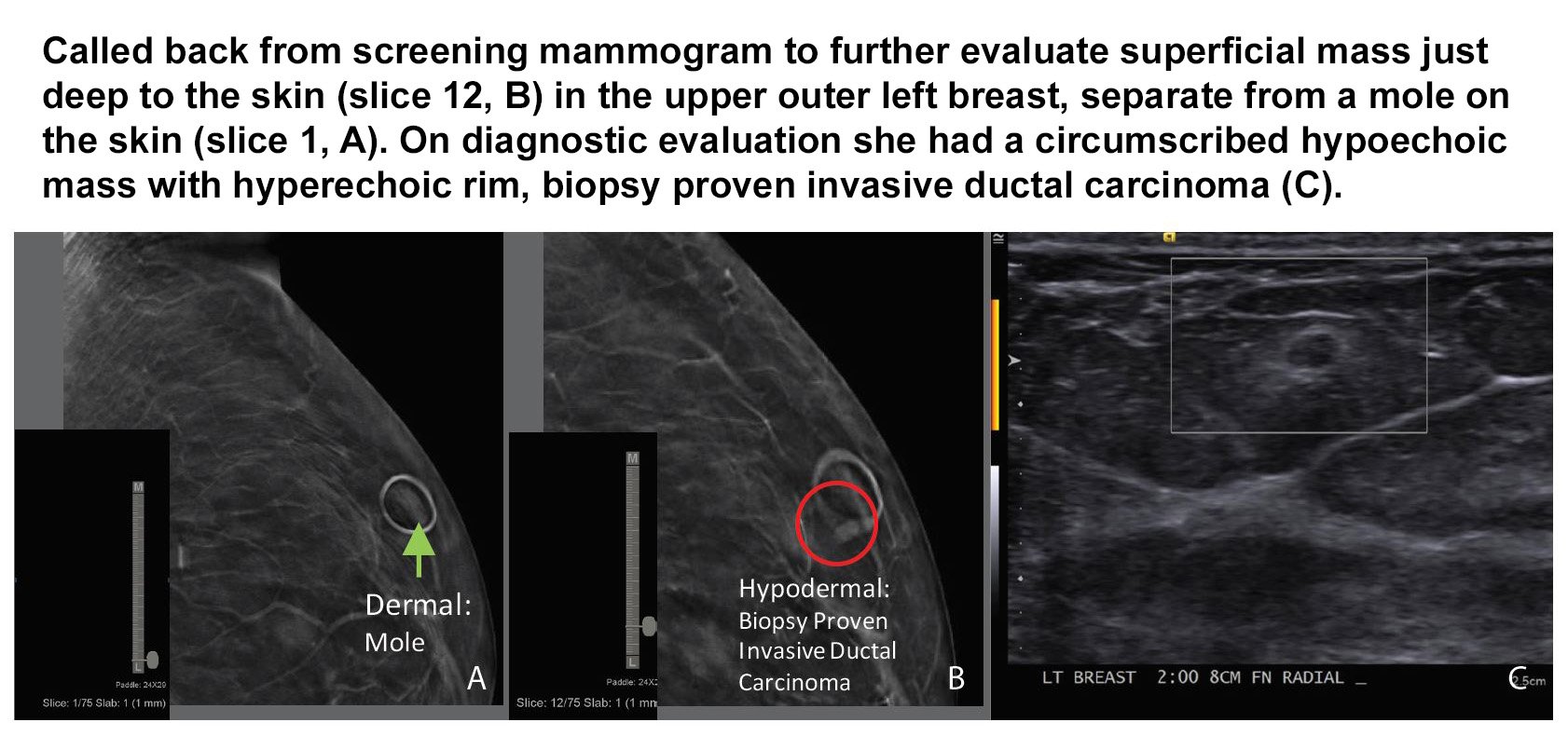 The Negative Fallout from Skin Tears in Mammography