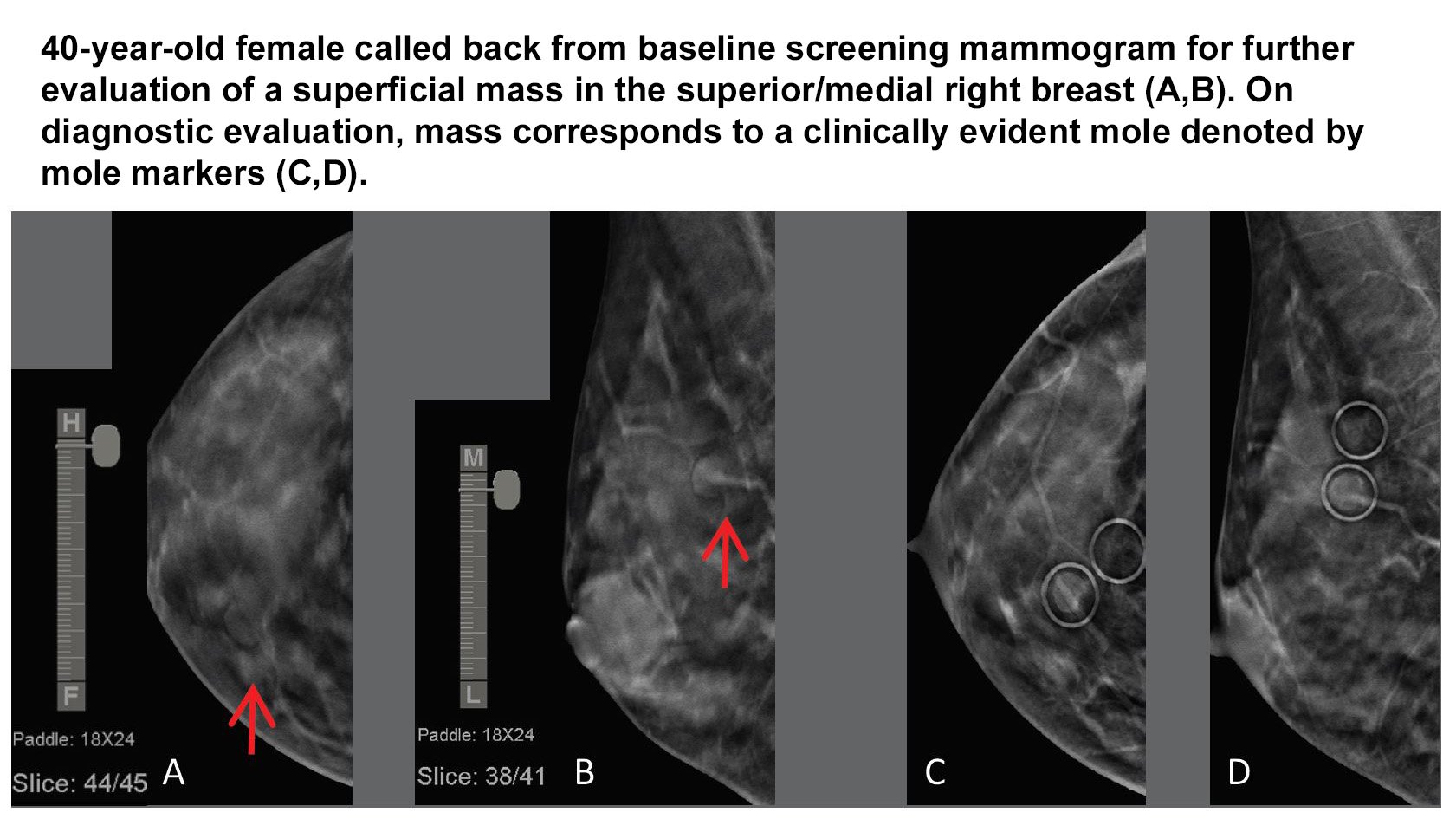 Study: 3D Mammograms Not Necessarily More Beneficial