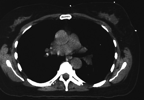 Axial slice showing 3-point setup of breast using CT-SPOT® pellet markers.  Note the crisp. clear imaging of the 3 markers used and absence of streaking artifact emanating from the areas marked.     