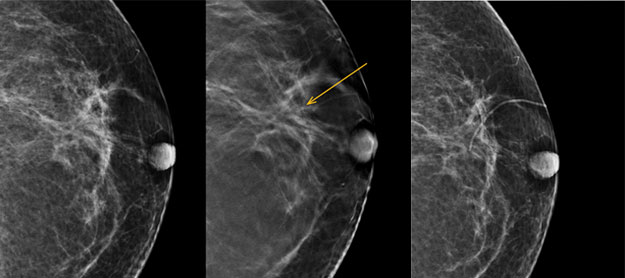 How DBT Has Radiologists Coming Full Circle Back to Marking Scars in Breast Imaging.