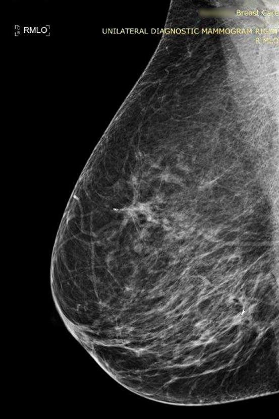 Architectural Distortion in 3D Mammography