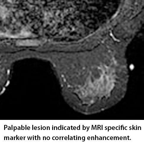 palpable lesion indicated by MRI specific skin marker