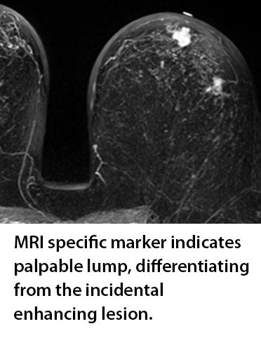 MRI specific marker indicates palpable lump
