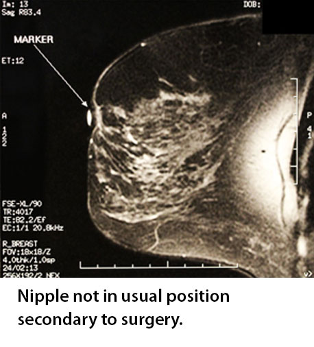Nipple not in usual position secondary to surgery
