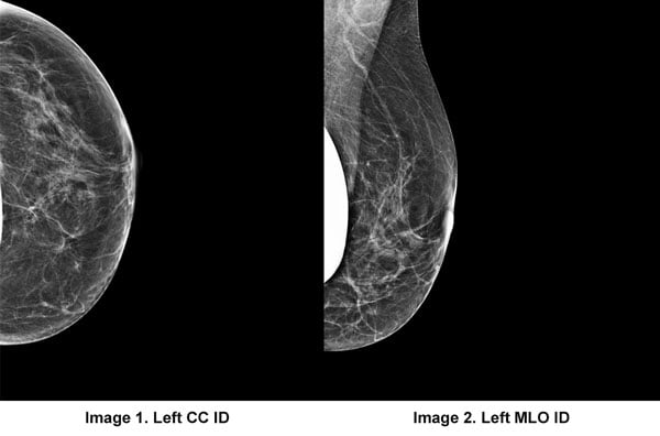 ABMR: The Future of Breast Cancer Screening?