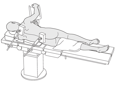 Lateral Decubitus position