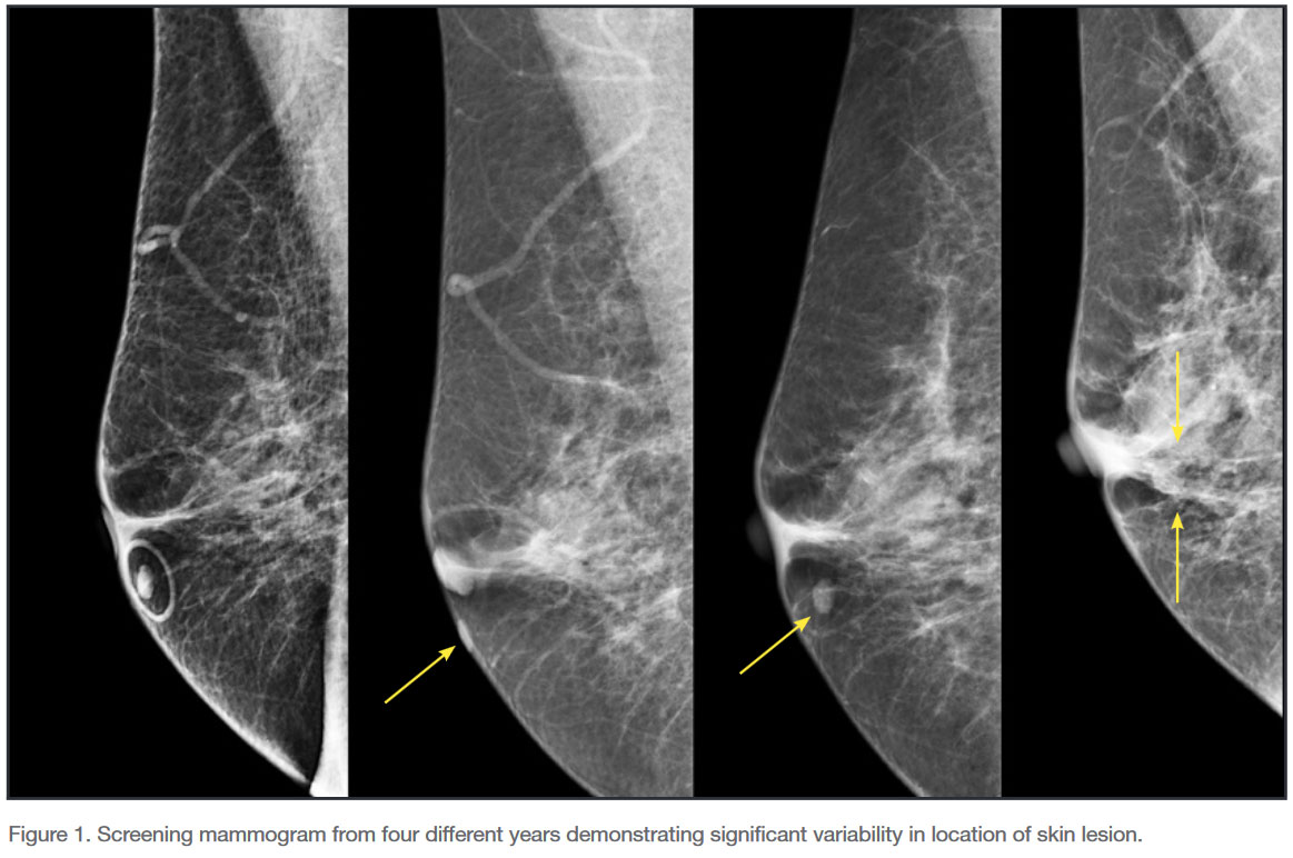 Screening mammogram from four different years demonstrating significant variability in location of skin lesion