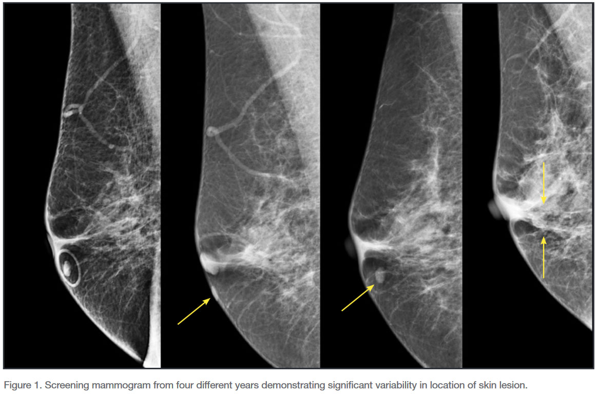 Radiologist Perspective on Benefits of Mammography Skin Markers to